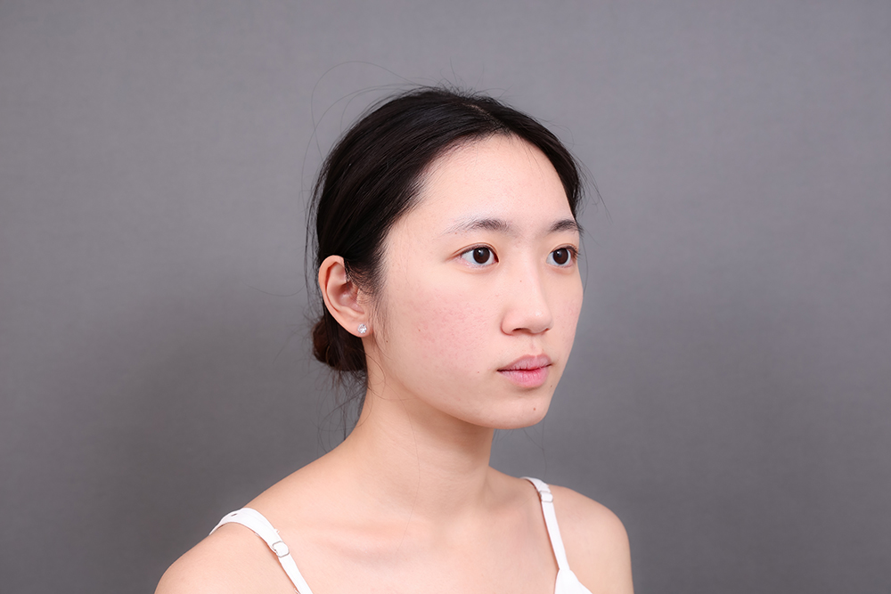 痘痘治療後的改善成果