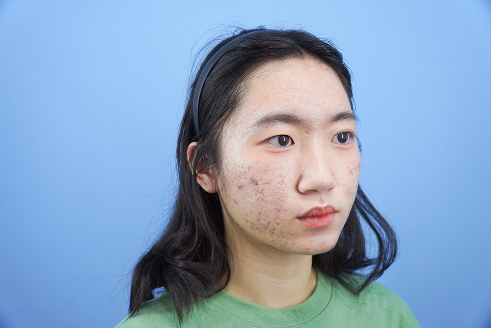 痘痘治療前的皮膚狀況