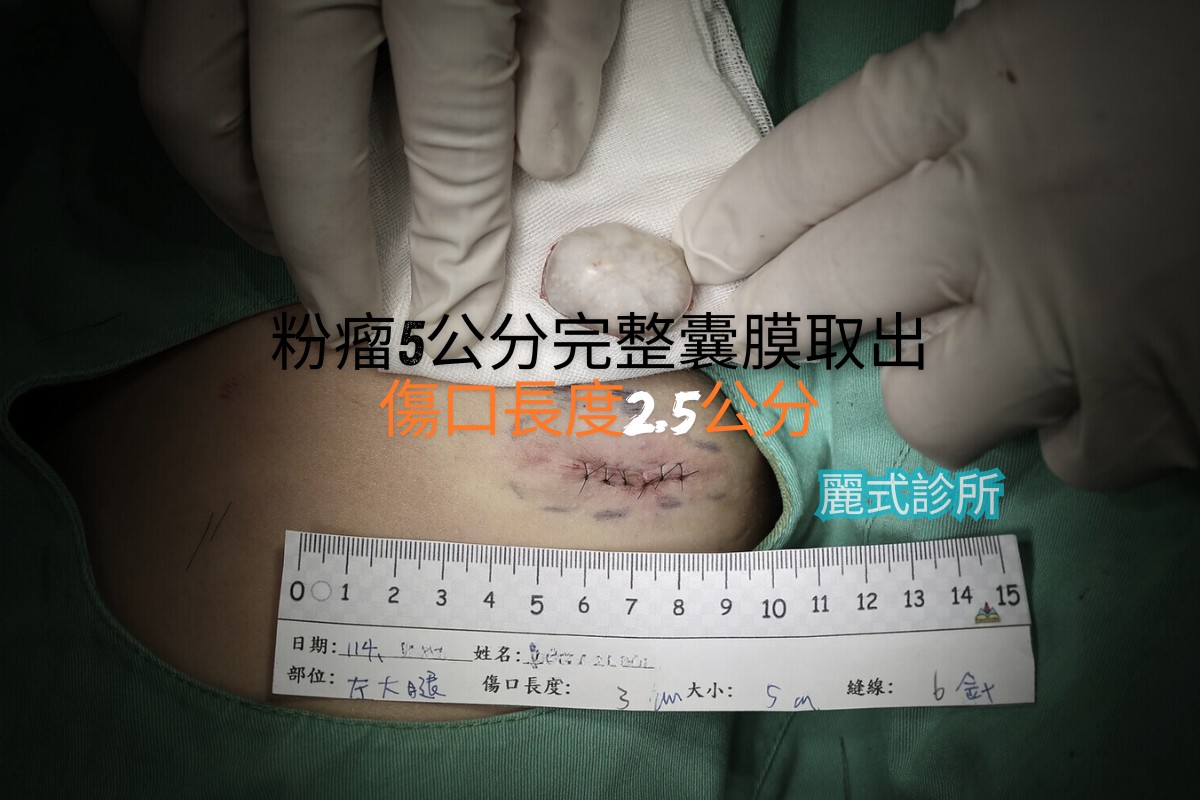 粉瘤微創切除 - 治療後