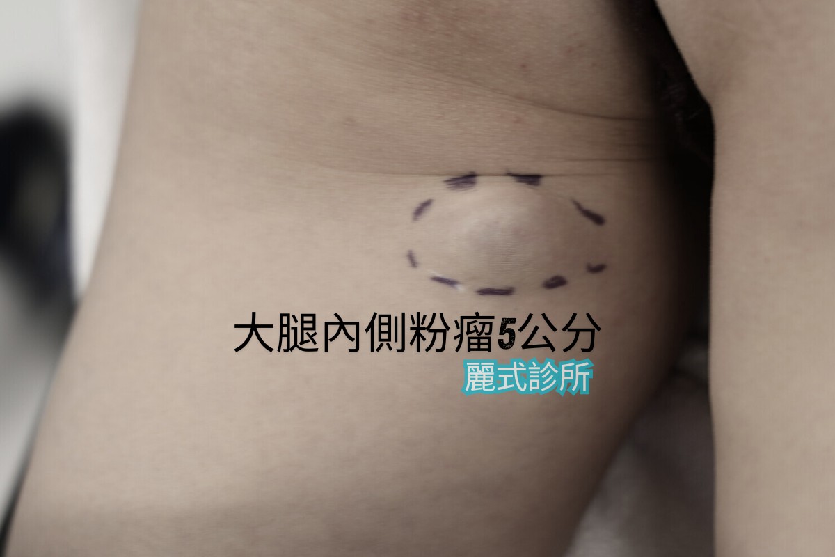 粉瘤微創切除 - 治療前