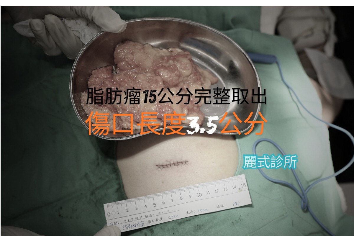 無痛脂肪瘤切除 - 治療後