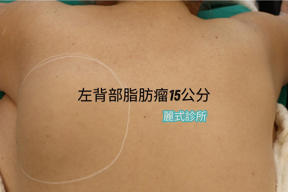 無痛脂肪瘤切除 - 治療前