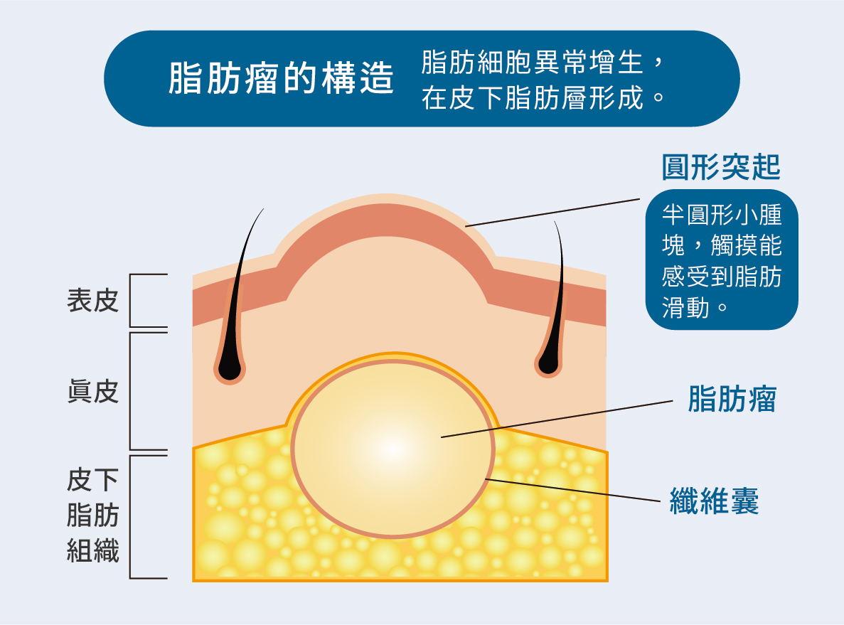 微創皮膚腫瘤切除：脂肪瘤、粉瘤切除全解析