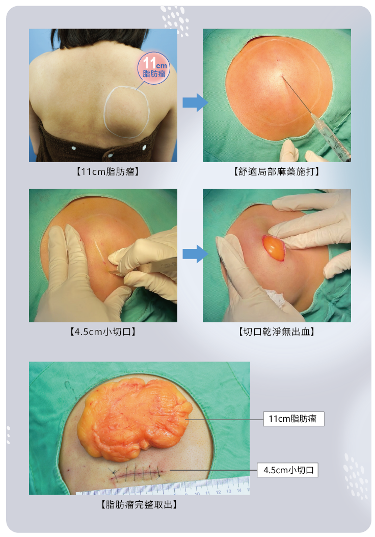 微創手術治療過程