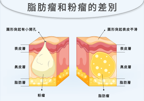 脂肪瘤與粉瘤的差別比較