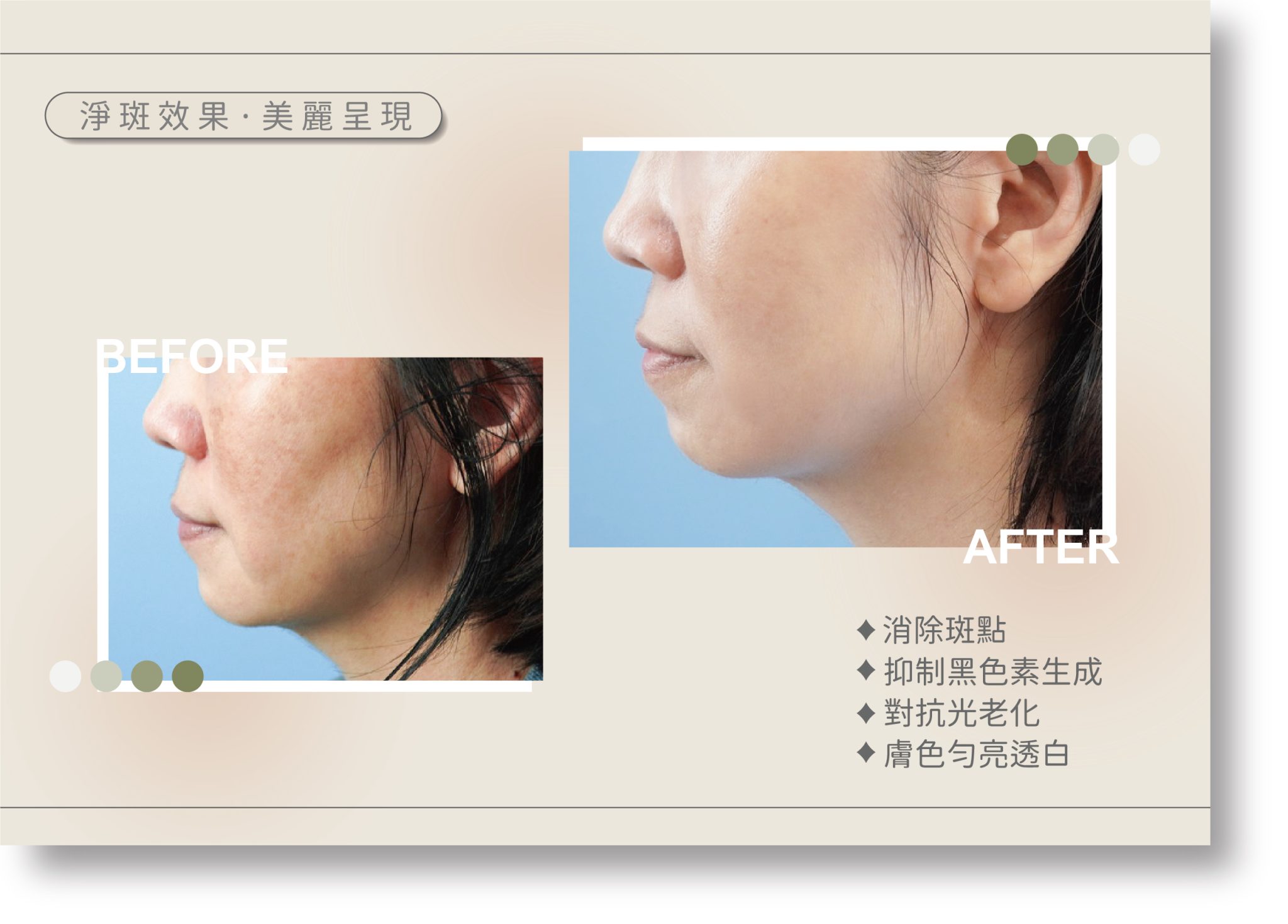 肝斑治療前後對比案例