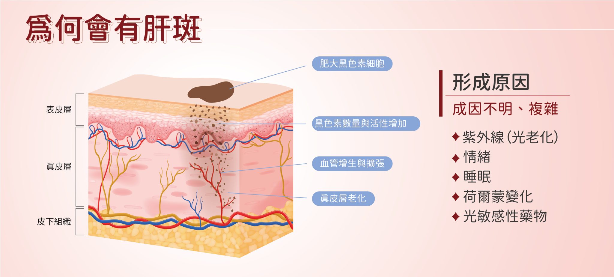 肝斑形成的主要原因