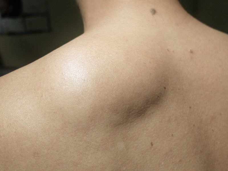 微創脂肪瘤切除