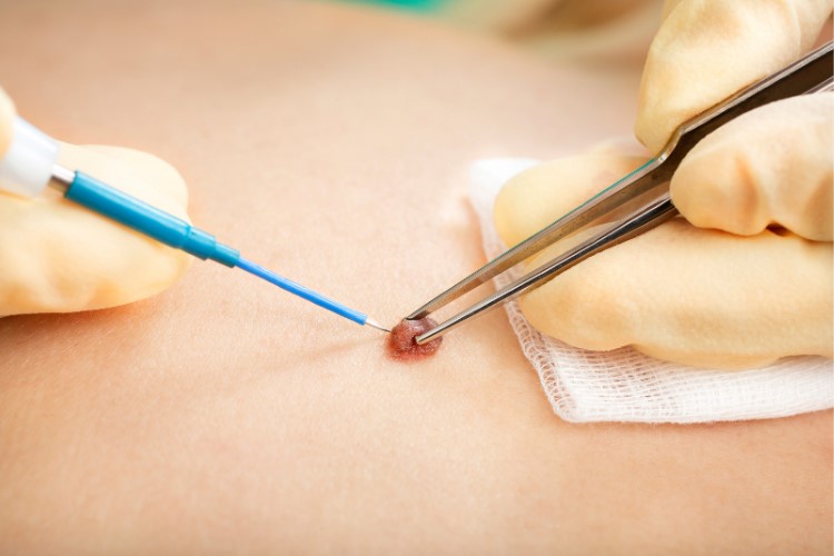 微創皮膚腫瘤切除